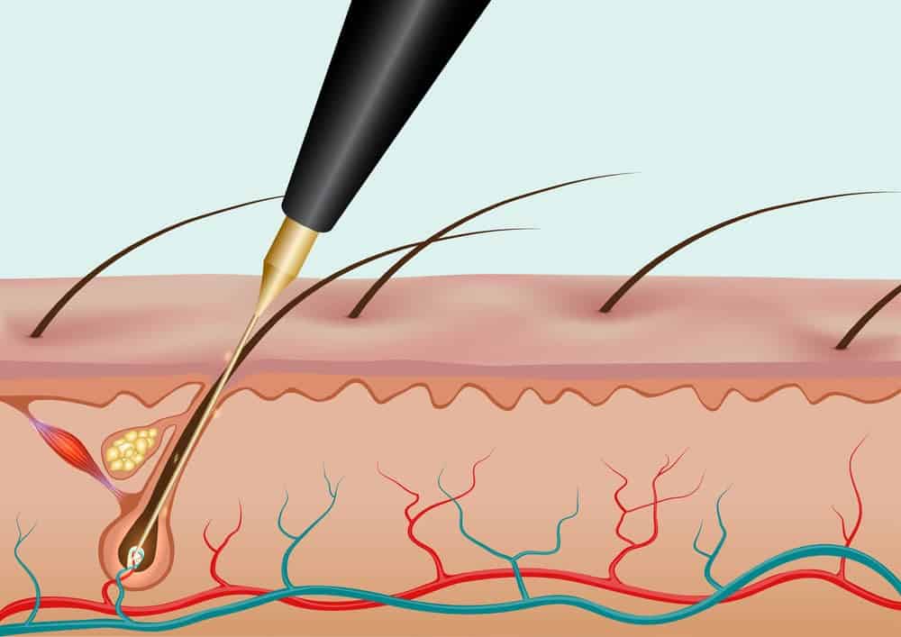 Electrolysis vs Laser Hair Removal What Are the Differences? Headcurve