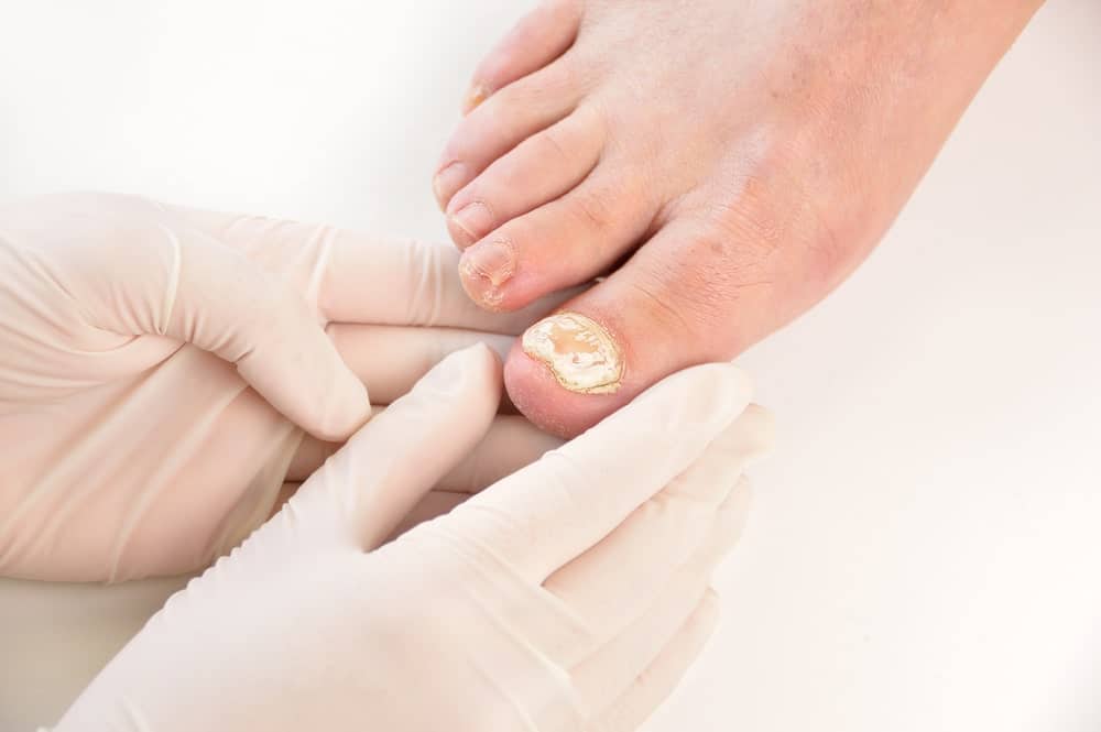 A healthcare professional inspecting a foot with toenail fungus.