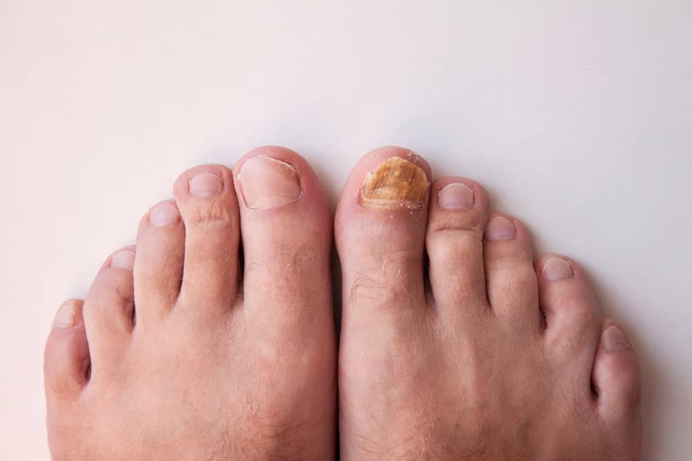 A comparison between healthy toenail and toenail with fungus.