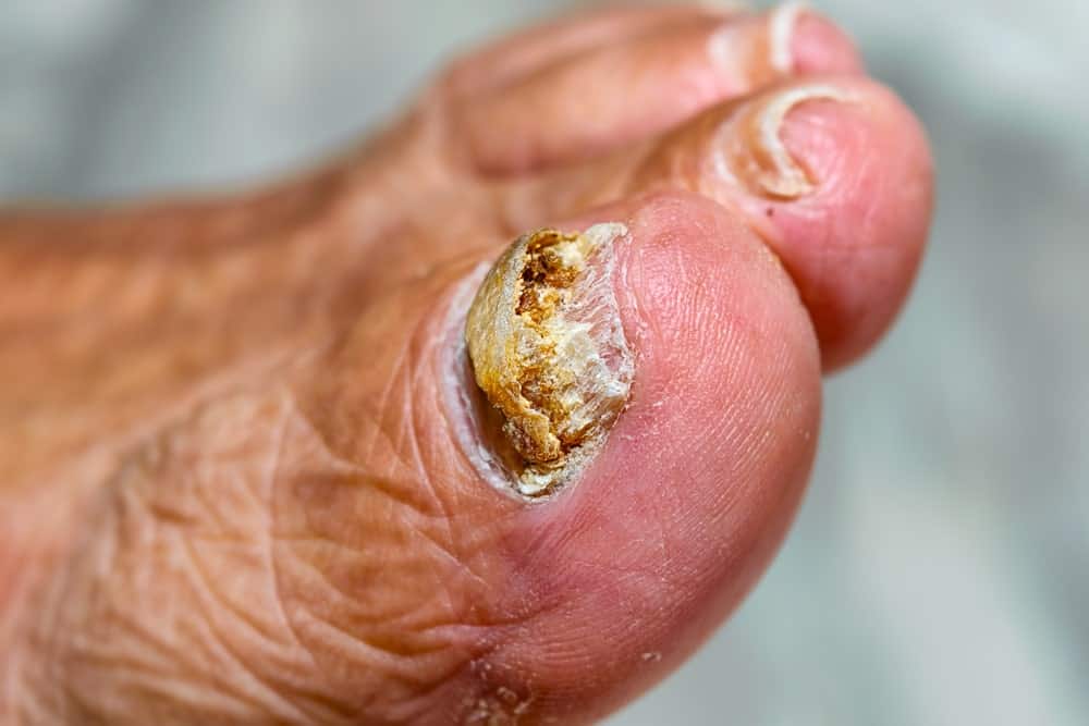 A toenail infected with fungus.