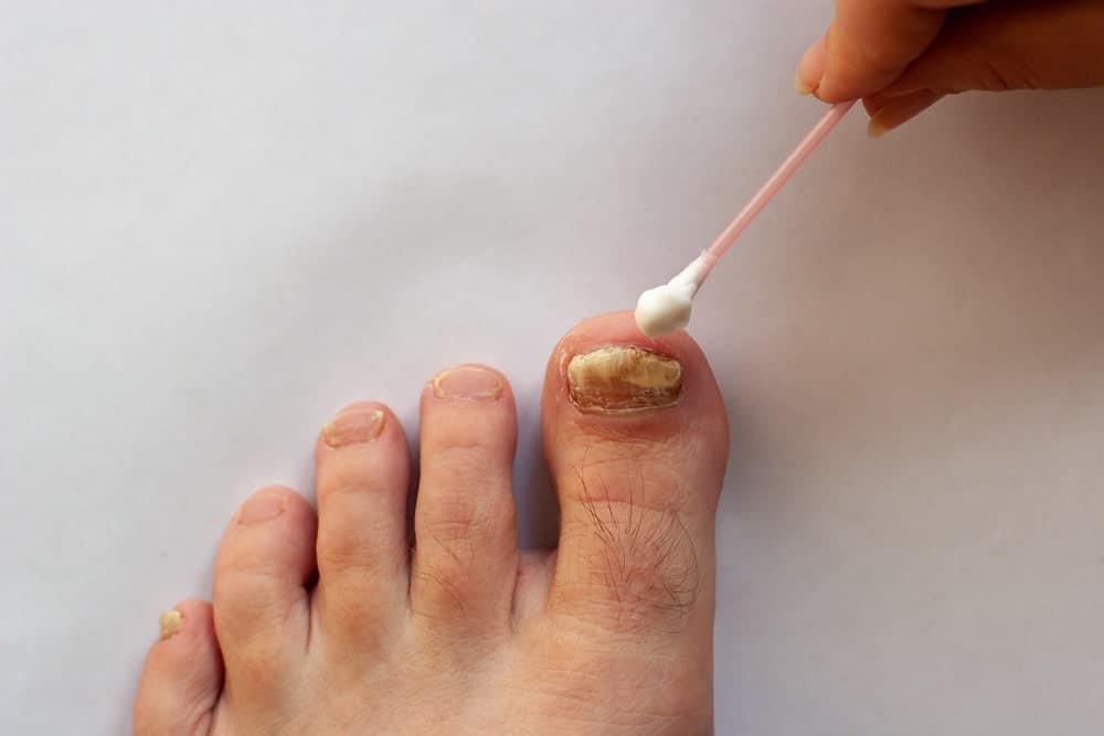An infected toenail with fungus being cared for.