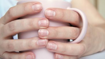 A close look at a woman's hands featuring fingernails with white spots.
