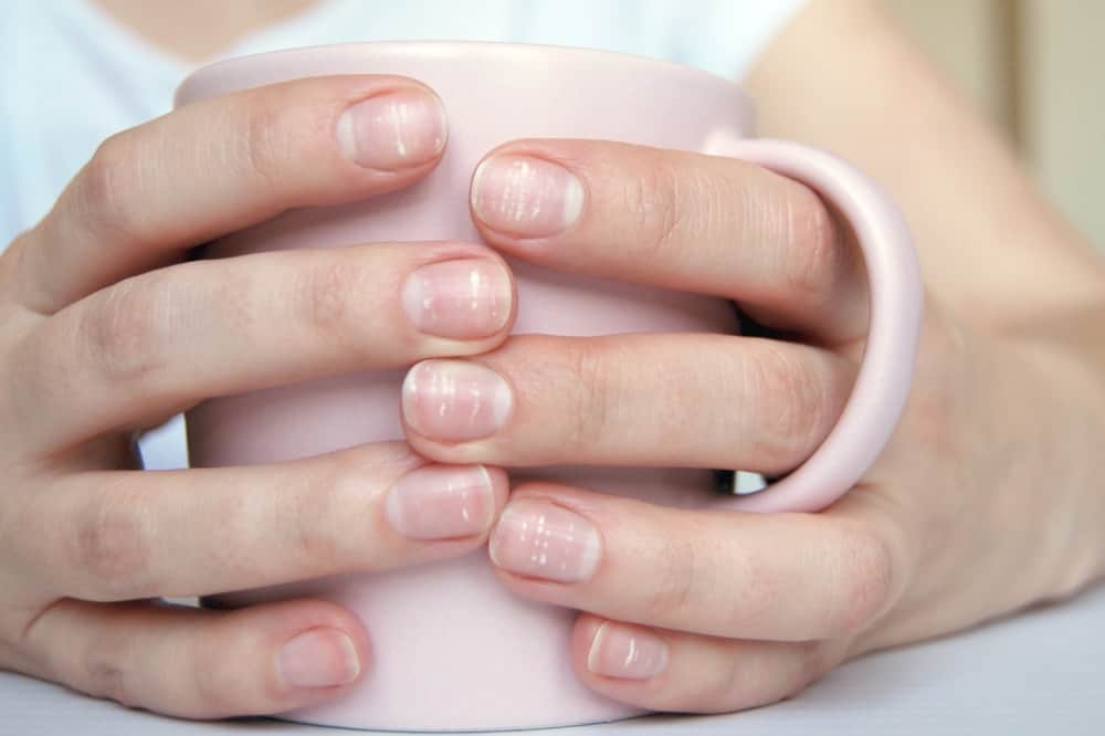 A close look at a woman's hands featuring fingernails with white spots.